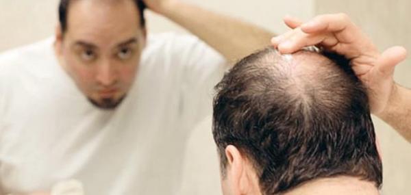 دراسة تُحذر: هذه المشروبات تؤدي إلى تساقط الشعر عند الرجال