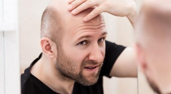 دراسة: مشروبات محبوبة تزيد من خطر تساقط الشعر لدى الرجال